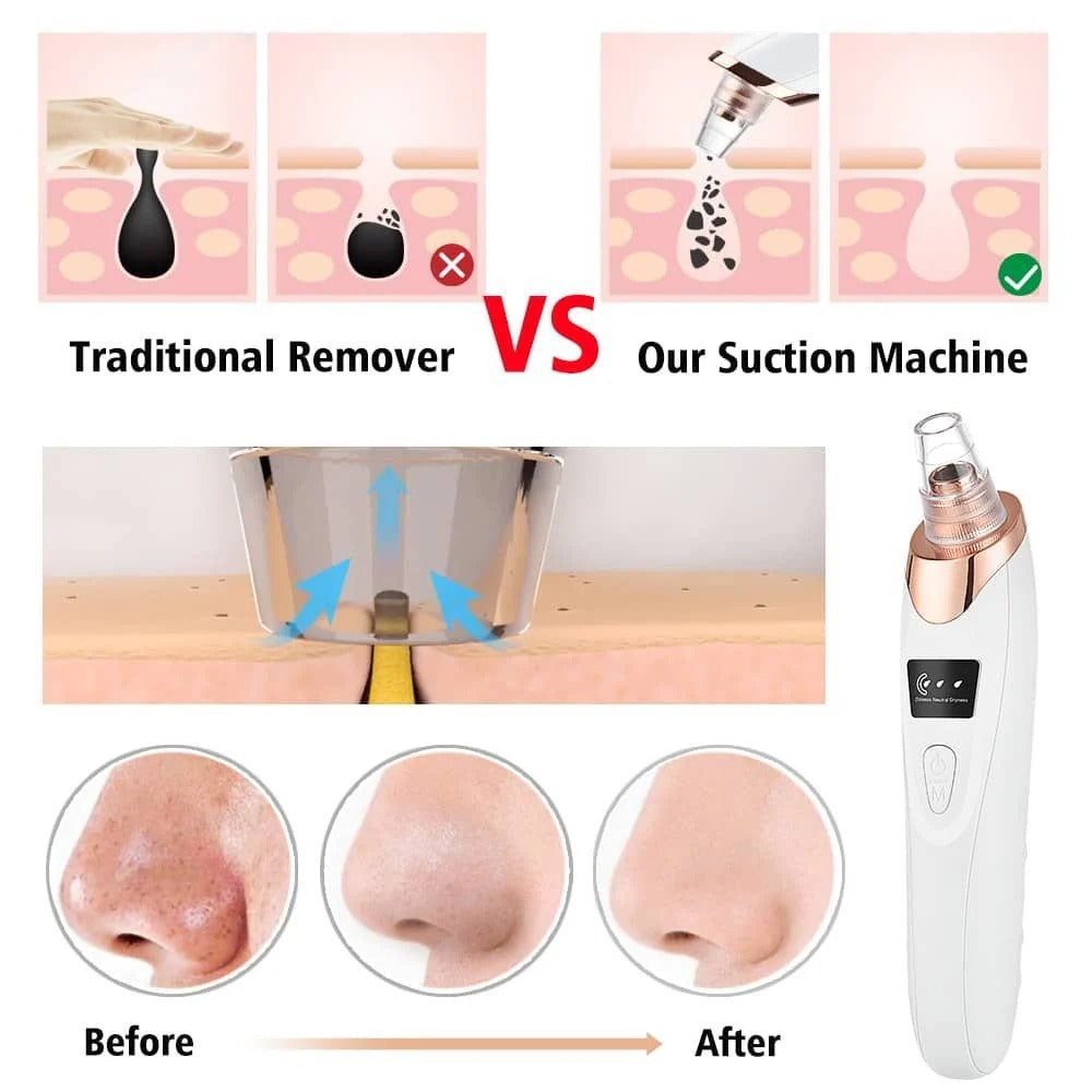Electric Blackhead Remover – Deep Pore Cleaning Device for Clear Skin